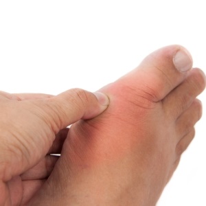 treat gout naturally