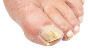 Nail Fungus