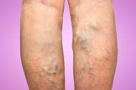 Varicose Veins Treatment